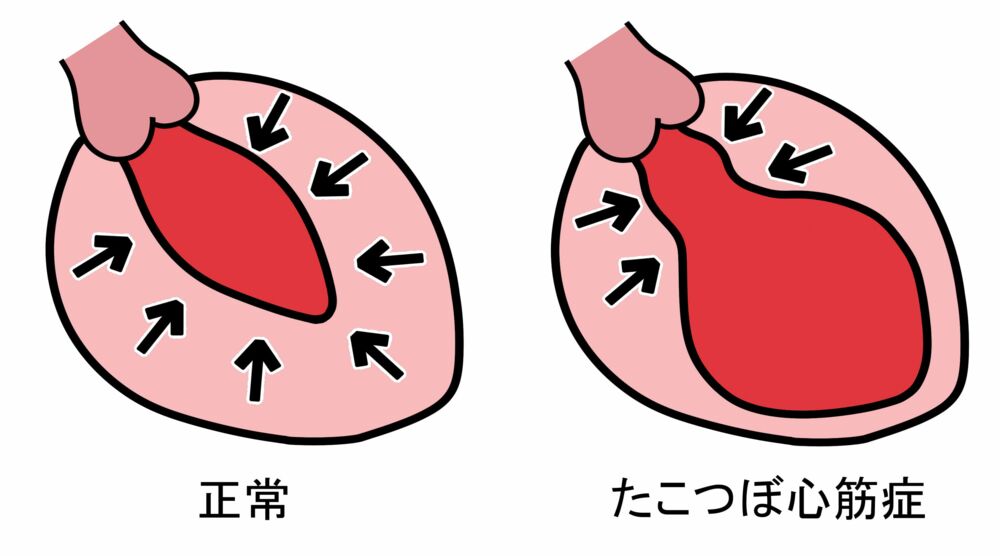 Takotsubo - das "Syndrom des gebrochenen Herzens"